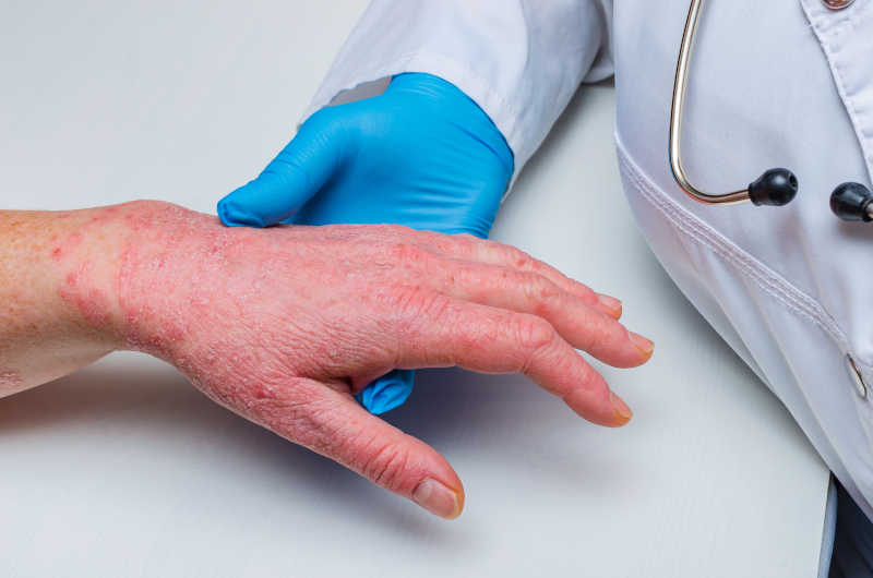 can you be allergic to nitrile or latex gloves